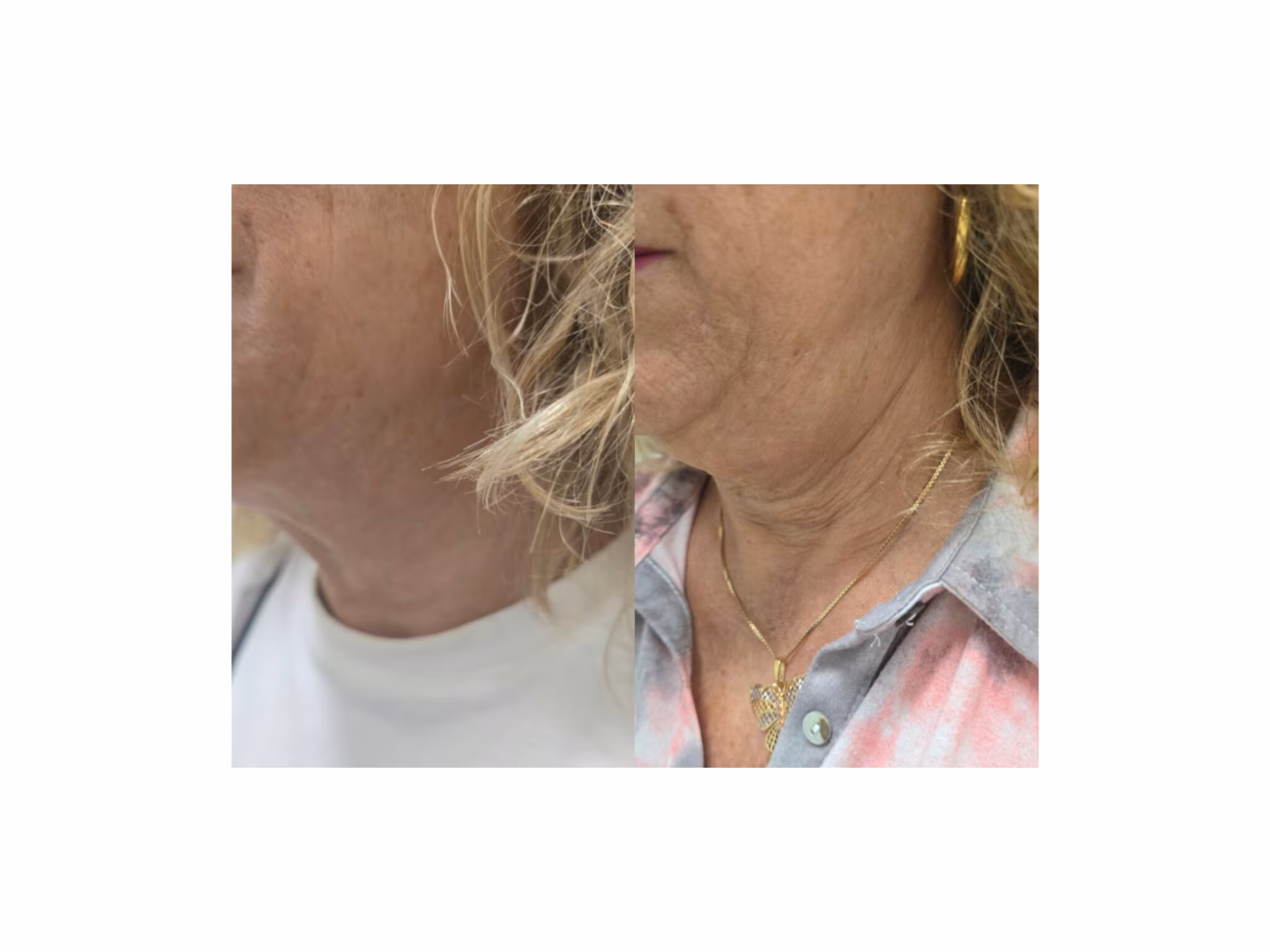 שופר גלריה - עבודת פיור סקין